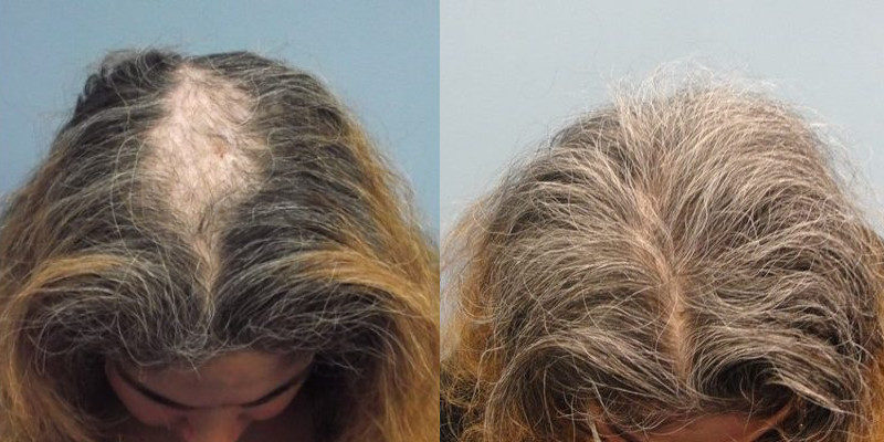 Hair Restoration With PRP Guilford, CT | The Langdon Center Hair Restoration With PRP Guilford, CT | The Langdon Center