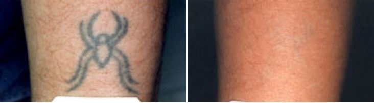 Laser Tattoo Removal Guilford
