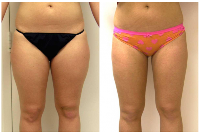 Liposuction guilford