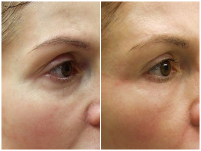 Natural Eyelid Lift Guilford