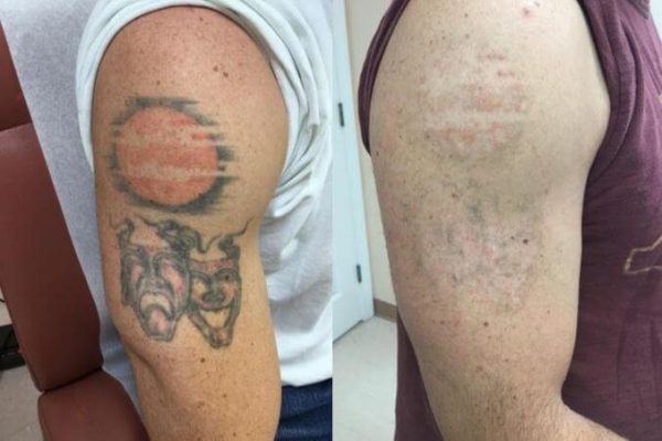 How Laser Tattoo Removal Works  EasyBlog Calvine Medical Aesthetics