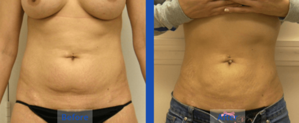 Lipo Guilford - the Langdon Center Lipo Guilford
