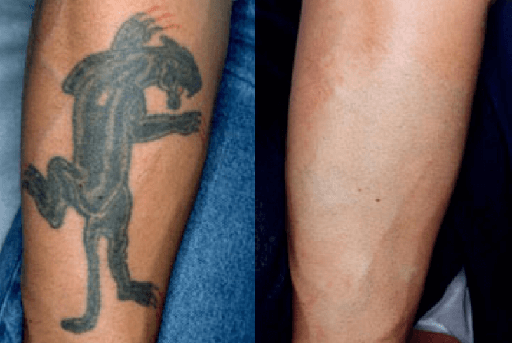 How to Prep for Laser Tattoo Removal