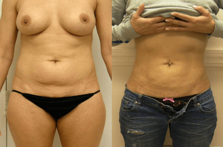 Liposuction in Guilford