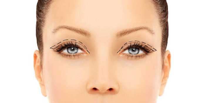 The Eye Have It, Even for Men: Top Eyelid Lift (Blepharoplasty) in Connecticut