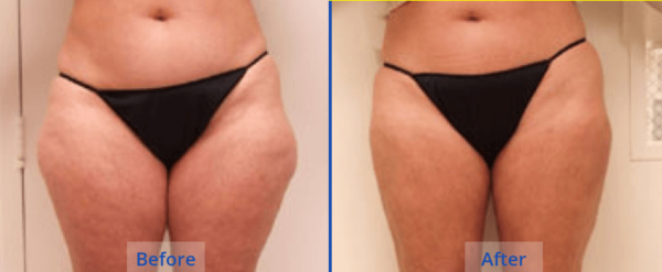 SlimLipo Connecticut nafter Guilford