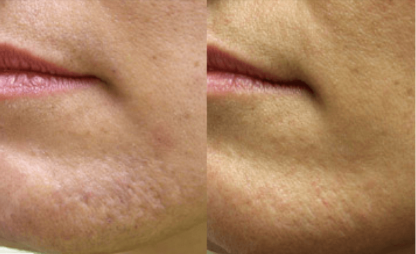 Acne Laser Treatment Guilford