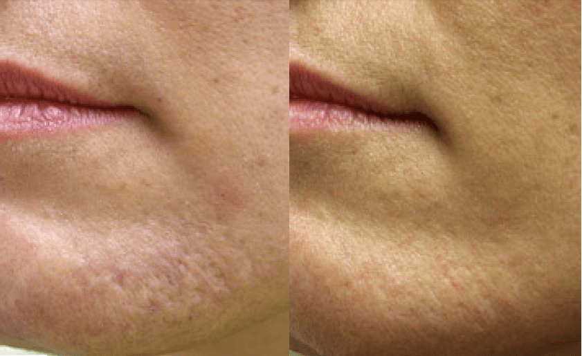 Acne laser treatment guilford