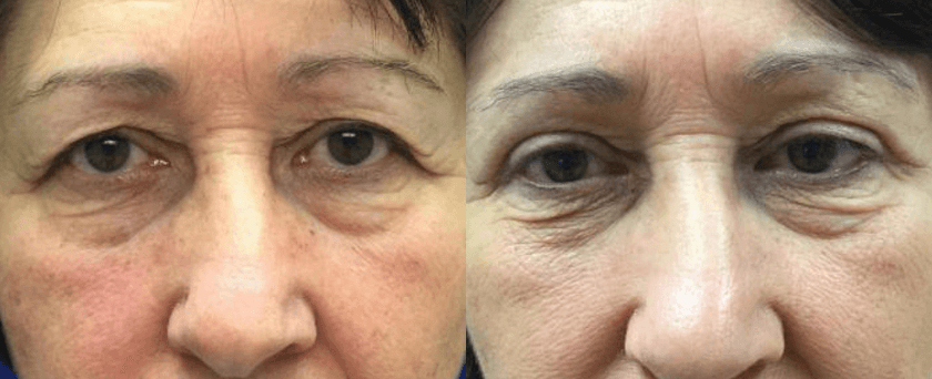 Blepharoplasty guilford