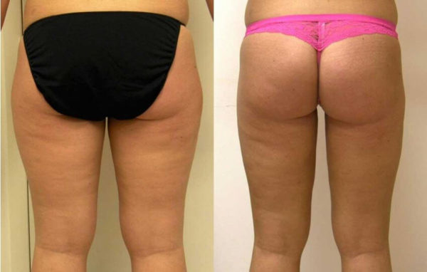 Liposuction Guilford