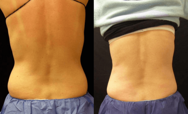 CoolSculpting® Upper Flanks