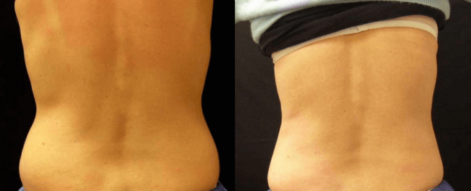 CoolSculpting Guilford