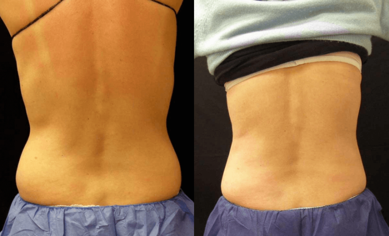 CoolSculpting Guilford