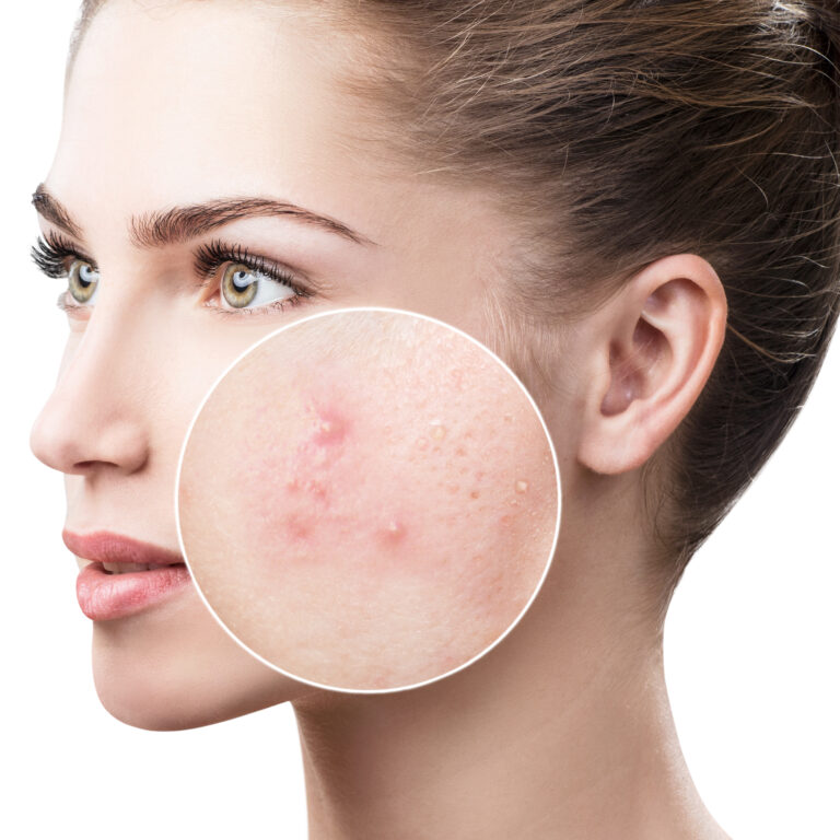 How Can I Eliminate Acne Scars?