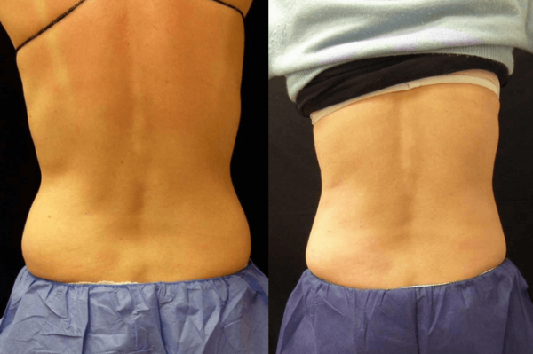 CoolSculpting Guilford