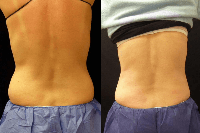 Coolsculpting guilford