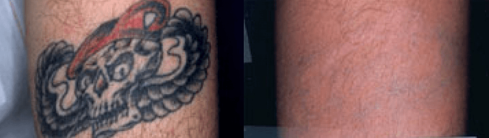 Tattoo Removal Guilford