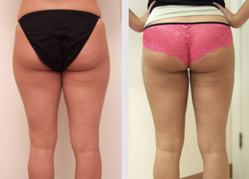 Liposuction Guilford