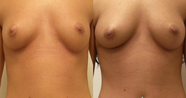 Breast Augmentation Guilford
