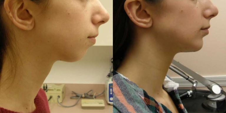 Chin Augmentation Connecticut