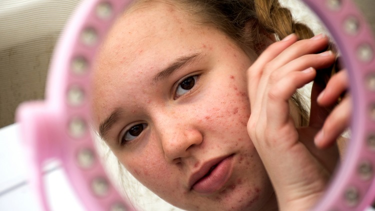 How Long Does It Take for Acne Scars to Fade?