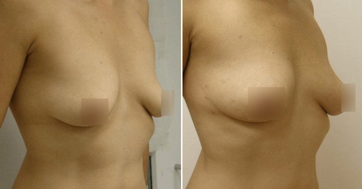 Breast Augmentation Guilford