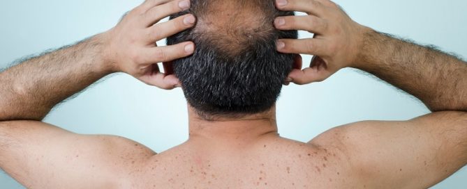 Hair restoration Guilford
