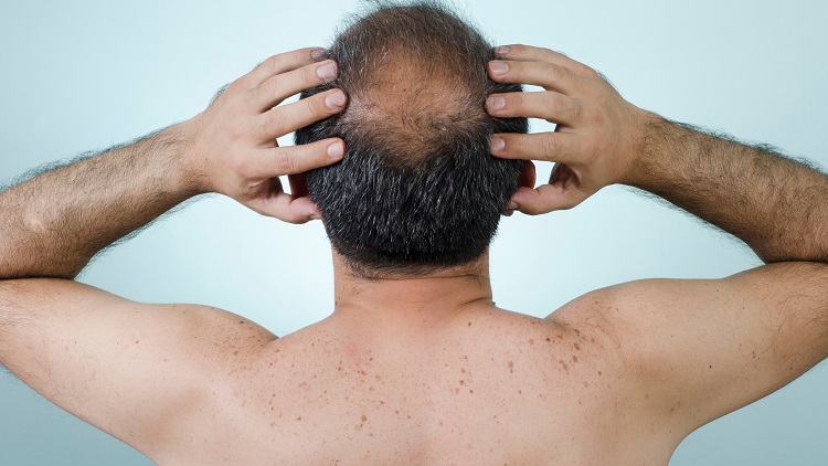 Hair restoration Guilford