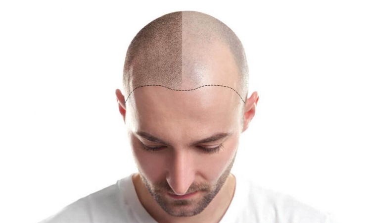 FUE Hair Transplant Guilford
