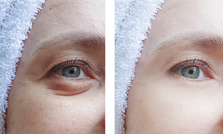 Can an Eyelid Lift Be Done Without a Scalpel?