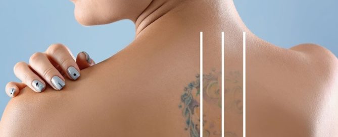 laser tattoo removal Guilford - The Langdon Center