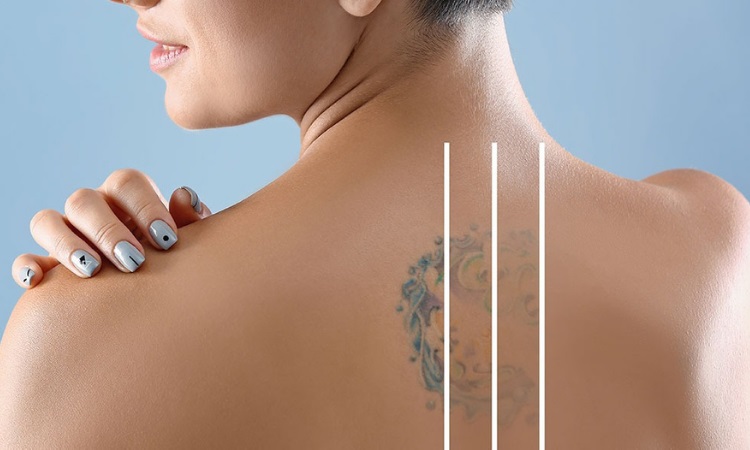 Laser Tattoo Removal Guilford