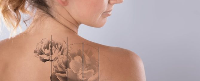 Laser Tattoo Removal Guilford