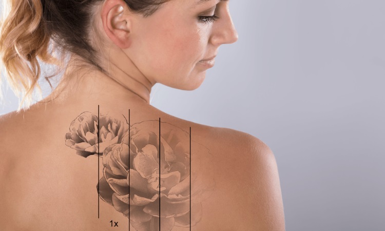 How Effective is Laser Tattoo Removal for Colors?