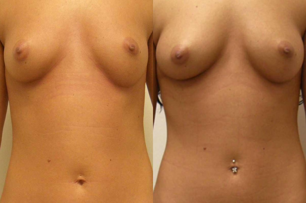 Natural Breast Augmentation Guilford
