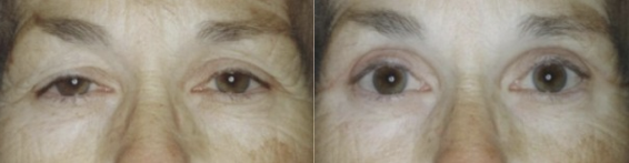 Blepharoplasty guilford