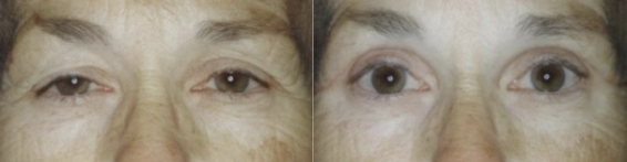 Blepharoplasty Guilford