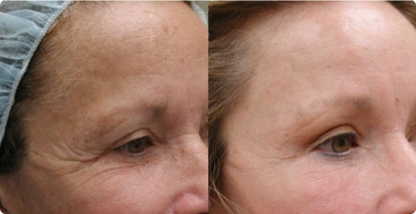 Brow lift guilford