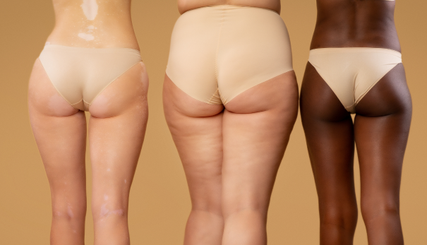 Cellulite Guilford - The Shoreline Center for Laser & Cosmetic Surgery Cellulite guilford