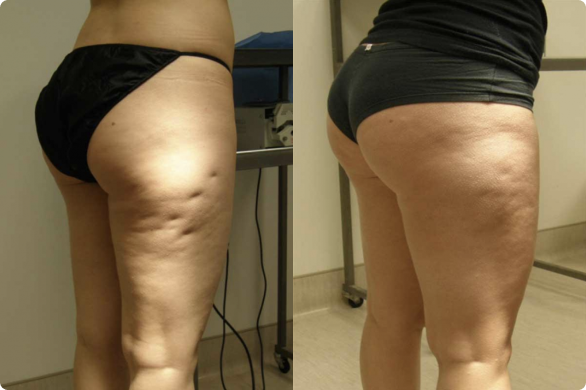 Cellulite Guilford - The Shoreline Center for Laser & Cosmetic Surgery Cellulite guilford