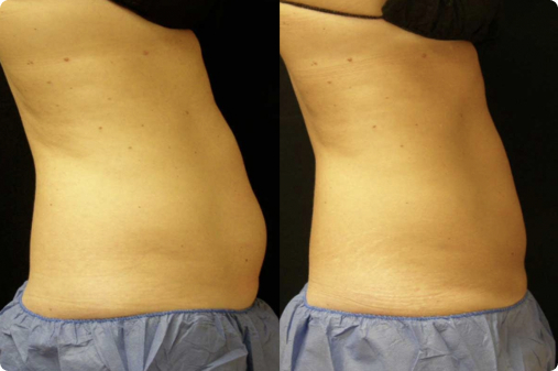 Coolsculpting guilford
