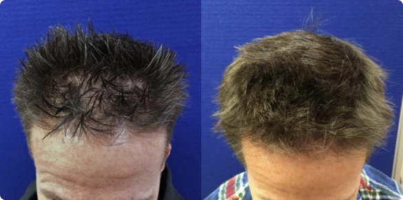 FUE-Hair-Transplant-Before-And-After - The Shoreline Center for Laser & Cosmetic Surgery Fue hair transplant before and after guilford