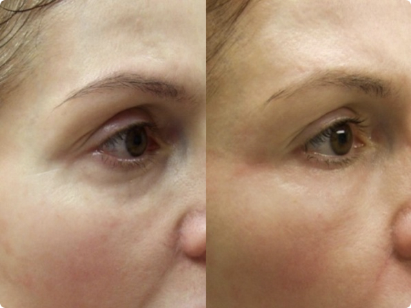 Facial Fat Transfer Guilford - The Shoreline Center for Laser & Cosmetic Surgery Facial fat transfer guilford