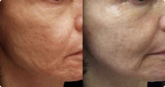 Fractional co2 laser guilford