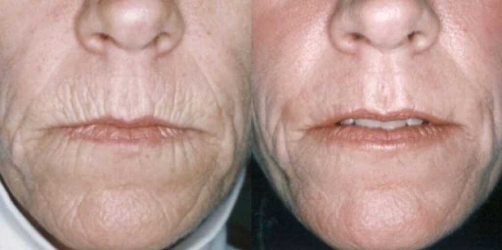 Laser Skin Resurfacing Dallas, TX