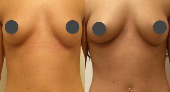 Breast Augmentation Guilford