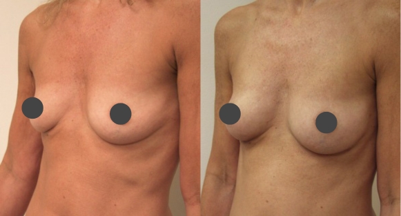 Breast augmentation guilford