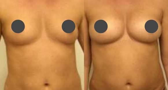 Breast augmentation guilford