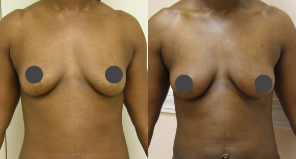 Breast augmentation guilford