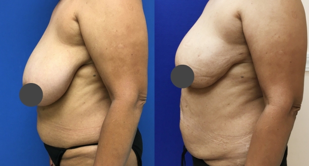 Breast reduction before and after